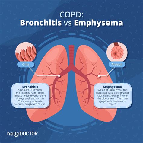 Hindi Nawawalang Ubo Heto Ang Posibleng Dahilan Ng Chronic Cough