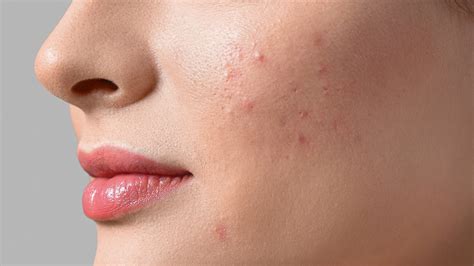 Adult Acne 101 Its Causes How To Treat It And Skincare Best Practices