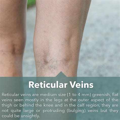 Reticular Veins