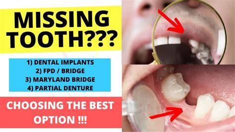 BEST Option For REPLACING A MISSING TOOTH Dental Clinic