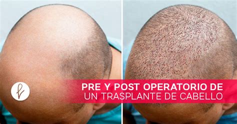 Pre Y Post Operatorio De Un Trasplante De Cabello Clínica Saint Paul