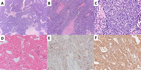 Histopathologic Diagnosis Of Neuroendocrine Neoplasms Of Head And Neck