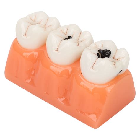 Modelo De Caries Dental Caries Dental De Resina Modelo De Caries De