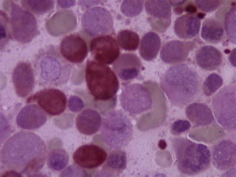 AML with inv (16) / M4Eo AML)