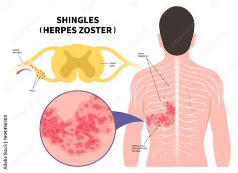 Deciphering The Shingles Nerve Pathways A Guide To Understanding The