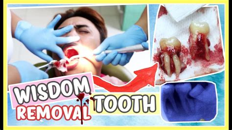 Wisdom Tooth Removal Process Extraction And Surgery 💜 Purpleheiress Youtube