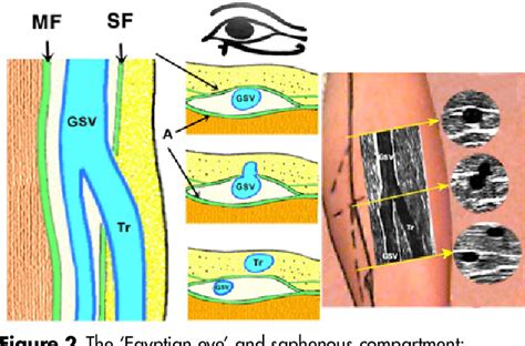 Figure 2 from Anatomy and embryology of the small saphenous vein: nerve ...