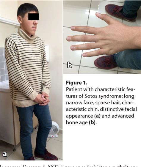 Figure 1 From Sotos Syndrome A Case Report Semantic Scholar