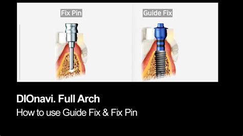 How To Fixate The Surgical Guide Guide Fix And Guide Fix Pin Youtube