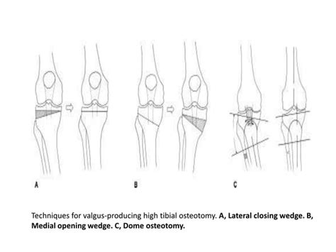 High tibial osteotomy | PPT