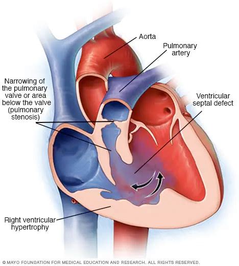 Tetralogy Of Fallot Symptoms And Causes Mayo Clinic