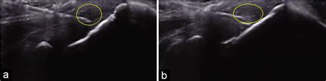 Ultrasound-Guided Percutaneous Needle Tenotomy for Tendinosis - Indian ...