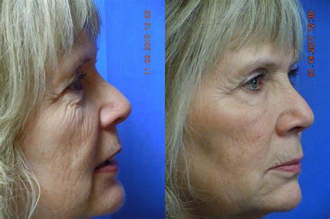 Dermal Fillers Vs Laser Skin Rejuvenation Which Is Right For You Dr