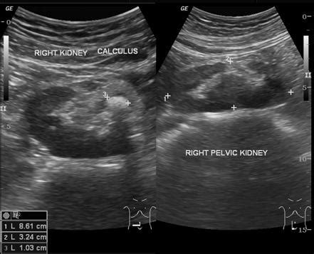 Kidney Stone Ultrasound