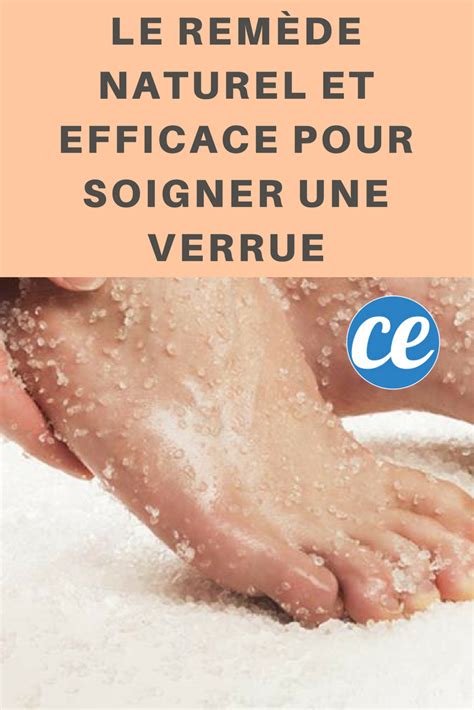 Le Remède Naturel et Efficace pour Soigner une Verrue Soigner une