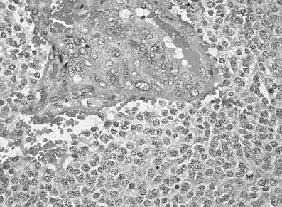 Anaplastic oligodendroglioma | Download Scientific Diagram