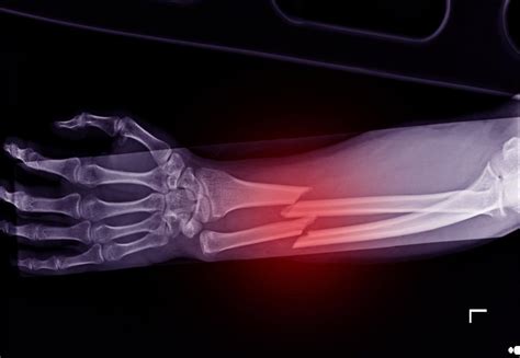 Complications Of A Bone Break Or Fracture Gainsberg Injury And