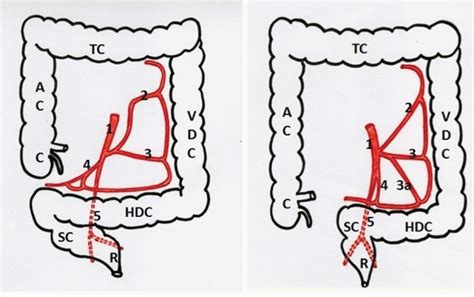 Right Sided Sigmoid Colon And Redundant Loop Of Descending Colon With