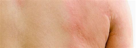 Chronic Hives Or A Rash Heres How To Tell—jax Allergy