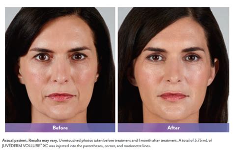 Nasolabial Folds Parentheses Rejuvenation Fillers NYC Top Ranked