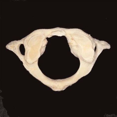 Superior View Of The Superior Articular Processes Of C1 Color Figure