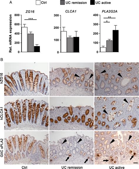 Epithelial Cells From Involved Colonic Uc Tissue Share A Panel Of