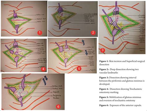 Digastric Trochantric Flip Osteotomy When and How to do it in ...