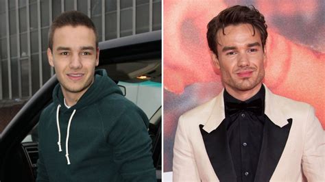 Did Liam Payne Get Plastic Surgery? Jaw, Face Photos | Life & Style