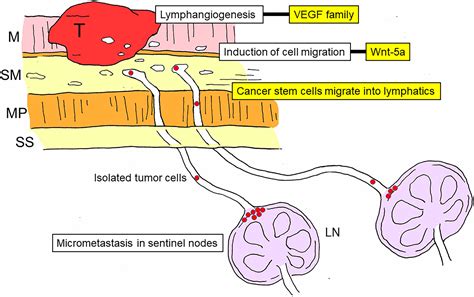 Frontiers Significance Of Lymph Node Metastasis In The Treatment Of Gastric Cancer And Current