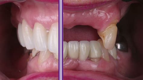 Before and After Partial Denture Replaced by a Zirconia Lingual with ...