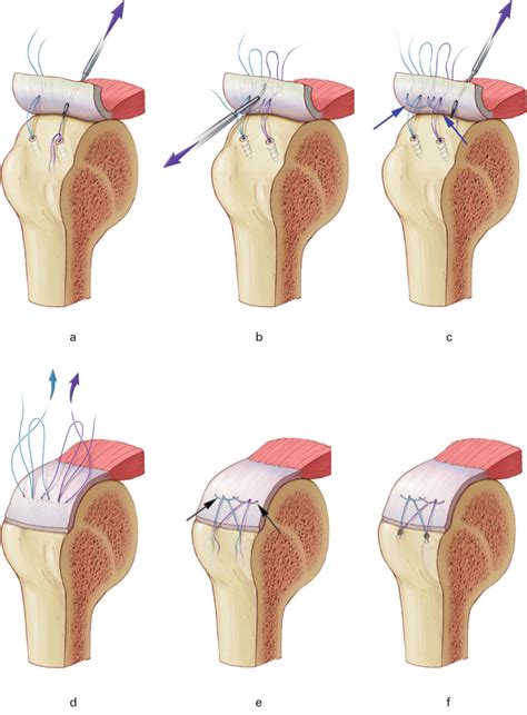 Biomechanical Evaluation Of A Novel Double Rip Stop Technique With