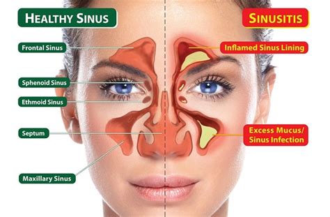 Neti Pot Diagram Of Sinus Wiring Diagram Pictures