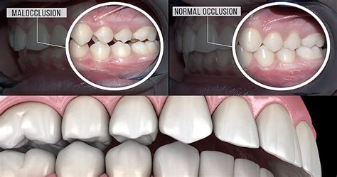 Overjet Como Corrigir Uma Mordida Acentuada