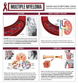 Multiple Myeloma Symptoms | Roswell Park Comprehensive Cancer Center - Buffalo, NY