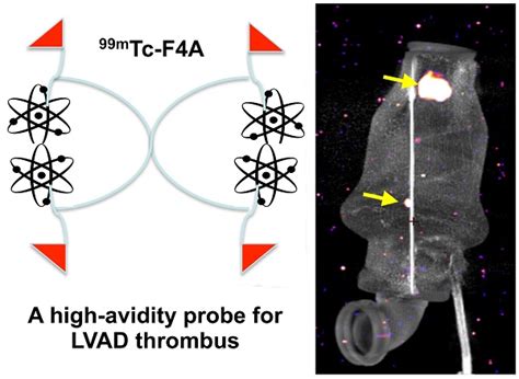 Diagnosis Of Lvad Thrombus Using A High Avidity Fibrin Specific Mtc Probe