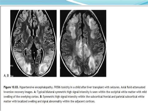 Radiology Of Demyelinating Diseases