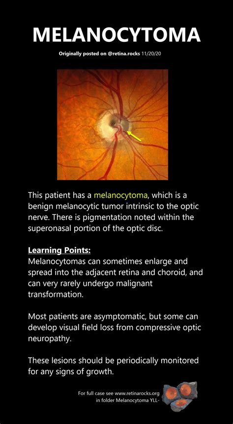 Optic Nerve Disorders Melanocytoma Retina Rocks