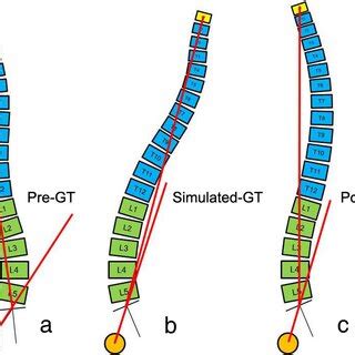 The Descriptions Of Sagittal Parameters Gt Global Tilt Sva Sagittal