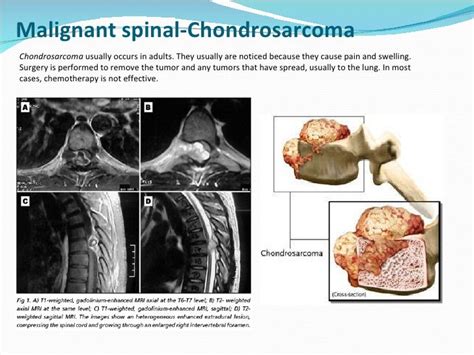 Spinal Tumors Lecture