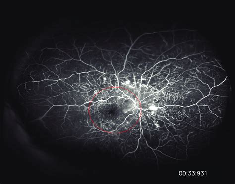 Corresponding Ultra Widefield Fluorescein Angiogram Of The Patient S