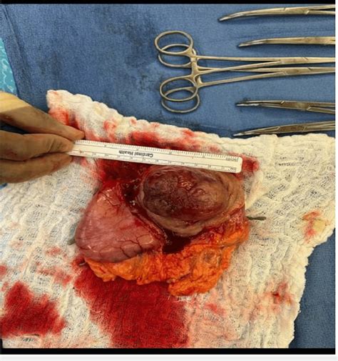 Resected Submucosal Tumor Resected Gastrointestinal Stromal Tumor