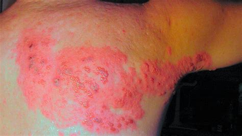 Shingles Rash On Inner Thigh