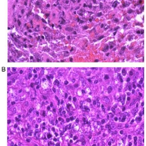 A Histological Examination Of Vocal Cord Biopsy Stained With