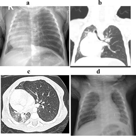 Severe Bronchomalacia Fish Mouth Appearance On Flexible Bronchoscopy
