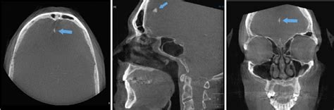 calcification   falx   axial view center   sagittal view