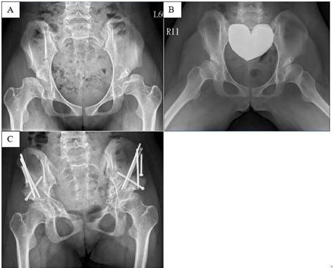 Figure 1 From The Early Outcome Of The Bernese Periacetabular Osteotomy