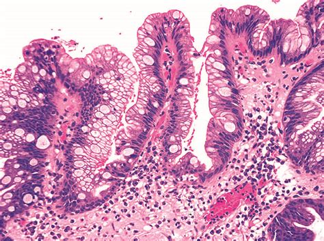 Pathology Outlines Barrett Esophagus BE