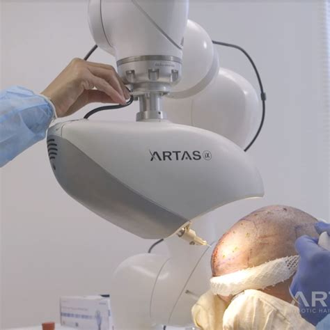 Artas Robotic Hair Restoration Myrtle Beach Coastal Dermatology Institute