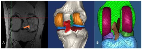 Jcm Free Full Text Biomechanical Difference Between Conventional