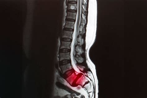 Espondilolistesis Patolog A De La Columna Vertebral